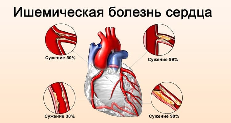 Ишемическая болезнь сердца - симптомы